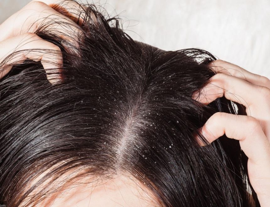 أسباب مشكلة الشعر الدهني وطرق العلاج