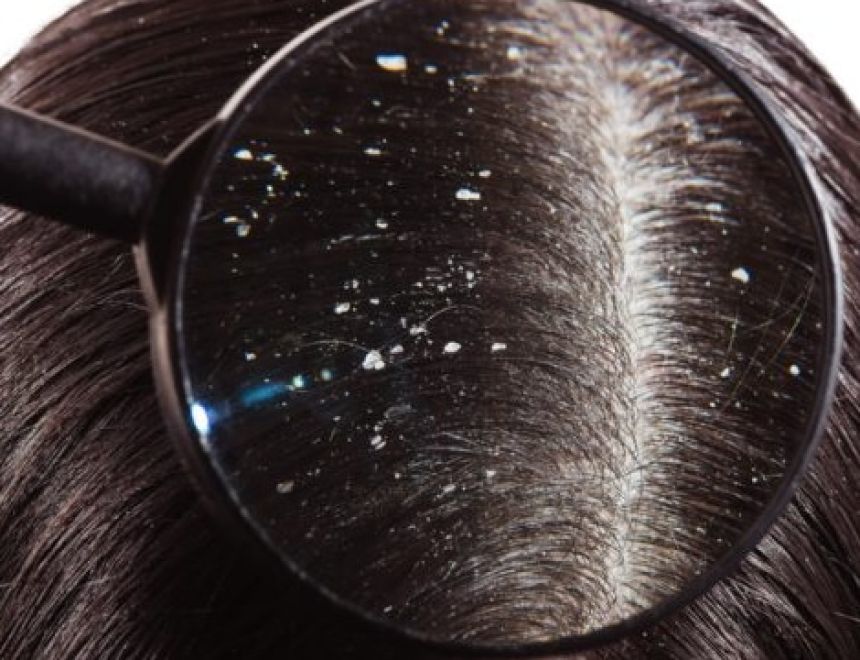ثلاثة وصفات طبيعية لعلاج القشرة من الشعر.. تعرفي عليهم