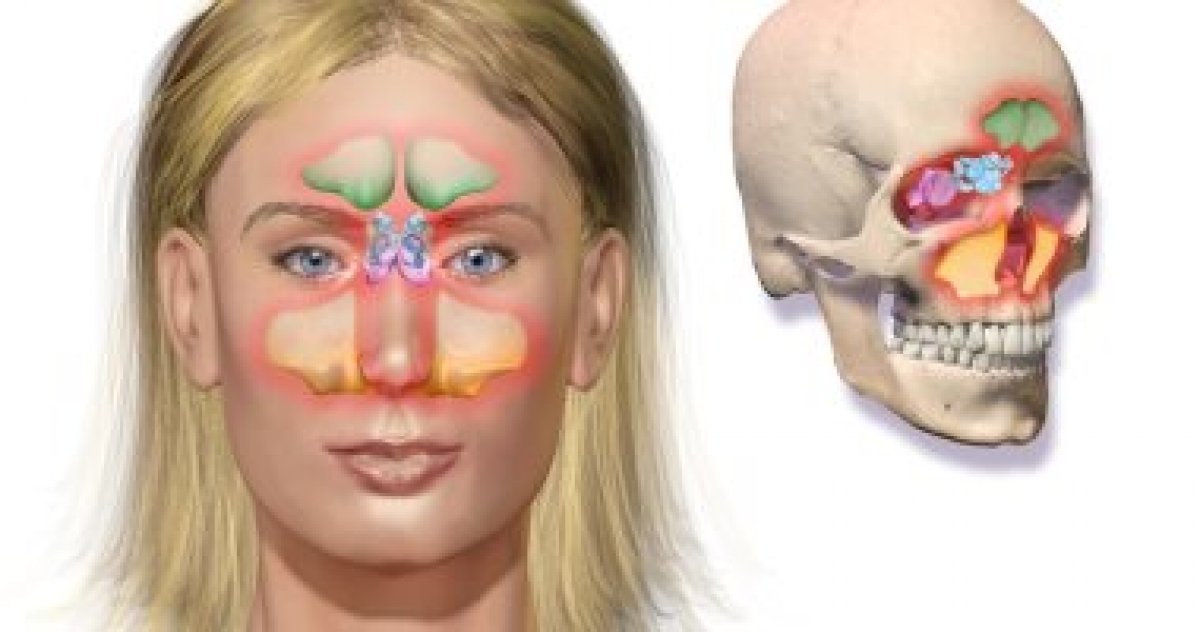  تعرف على تشابه أعراض نزلة البرد إلى حد كبير مع أعراض التهابات الجيوب الأنفية