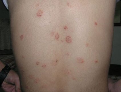 بالتشابه مع أعراض الكورونا، مرض جلدي منتشر بين الأطفال والمراهقين.. فما هو؟