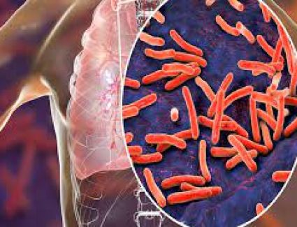 مصر تسعي إلى مكافحة وباء السل و خفض المعدلات الإصابات 