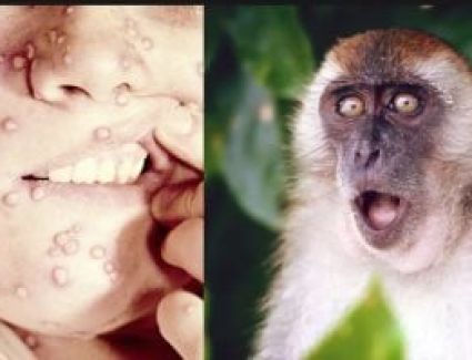 كل ما تريد معرفته عن جدرى القرود.. التقبيل ينقل العدوى والوقاية بلقاح